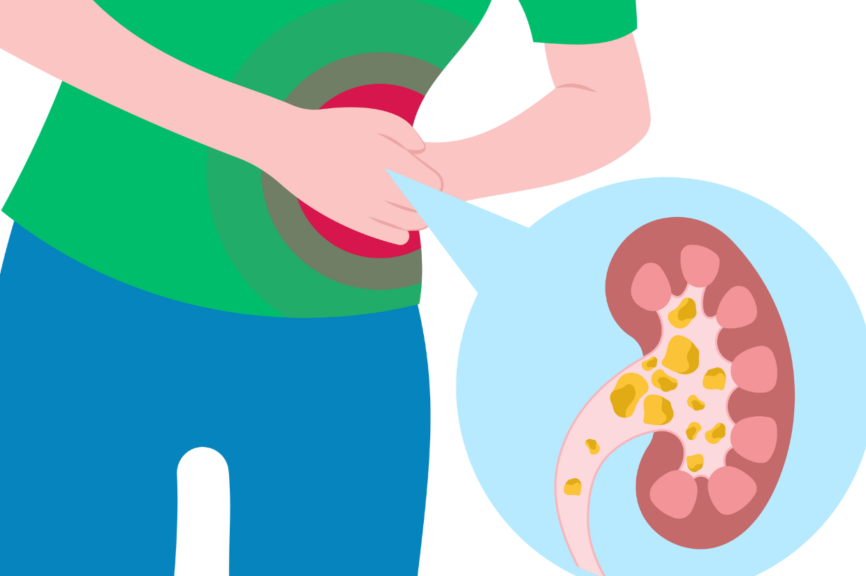 Best Strategies and Therapies for the Treatment of Lupus Nephritis