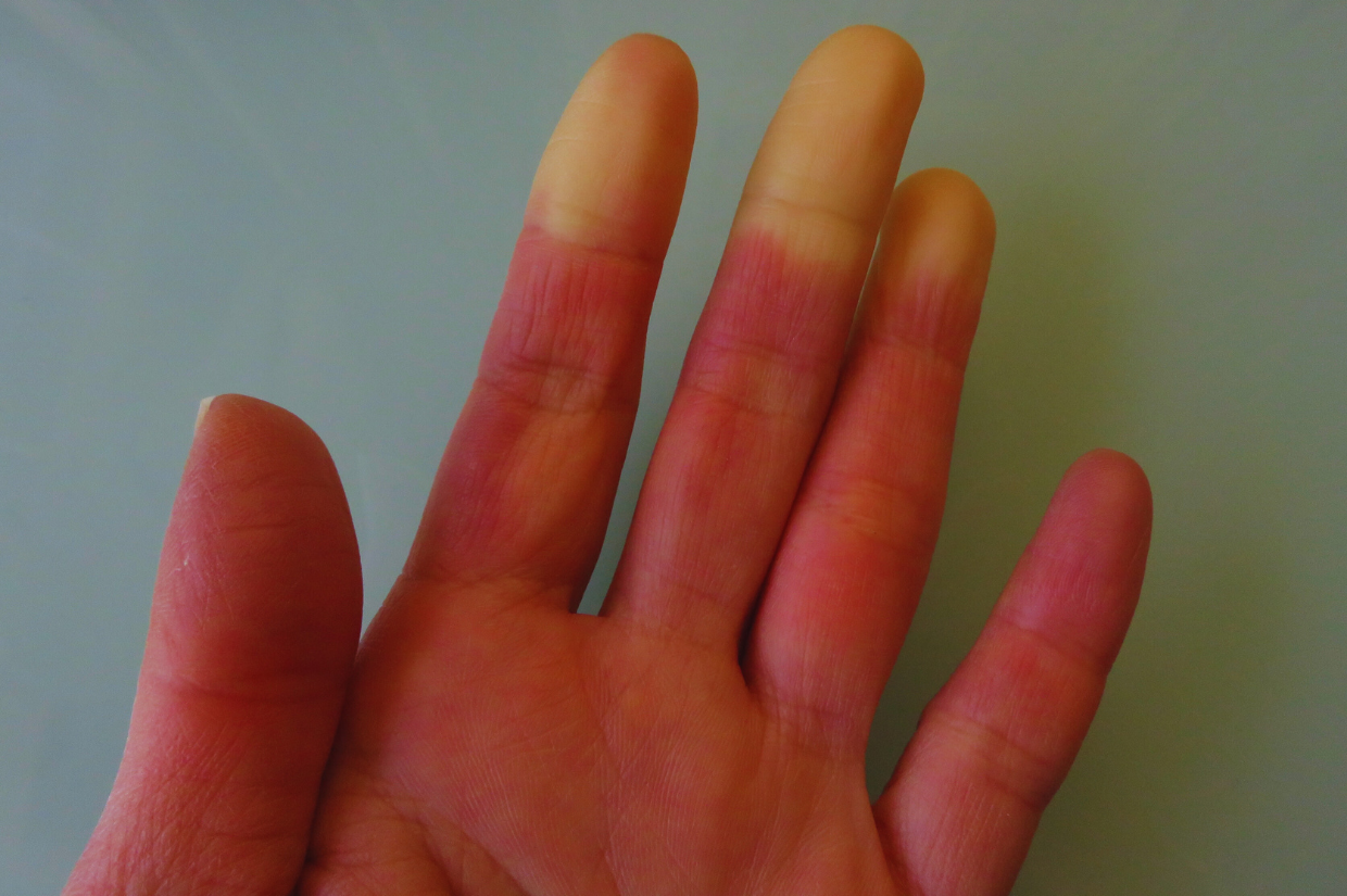 Scleroderma Signs: Recognizing the Symptoms and Early Warning Signs