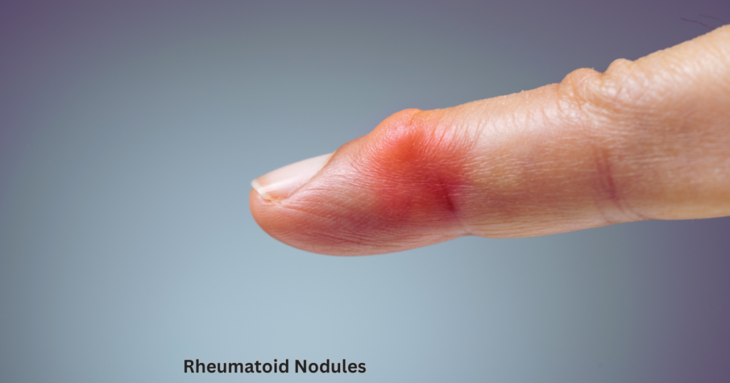 Explore the causes, symptoms, and treatments for rheumatoid nodules, a common symptom of rheumatoid arthritis.