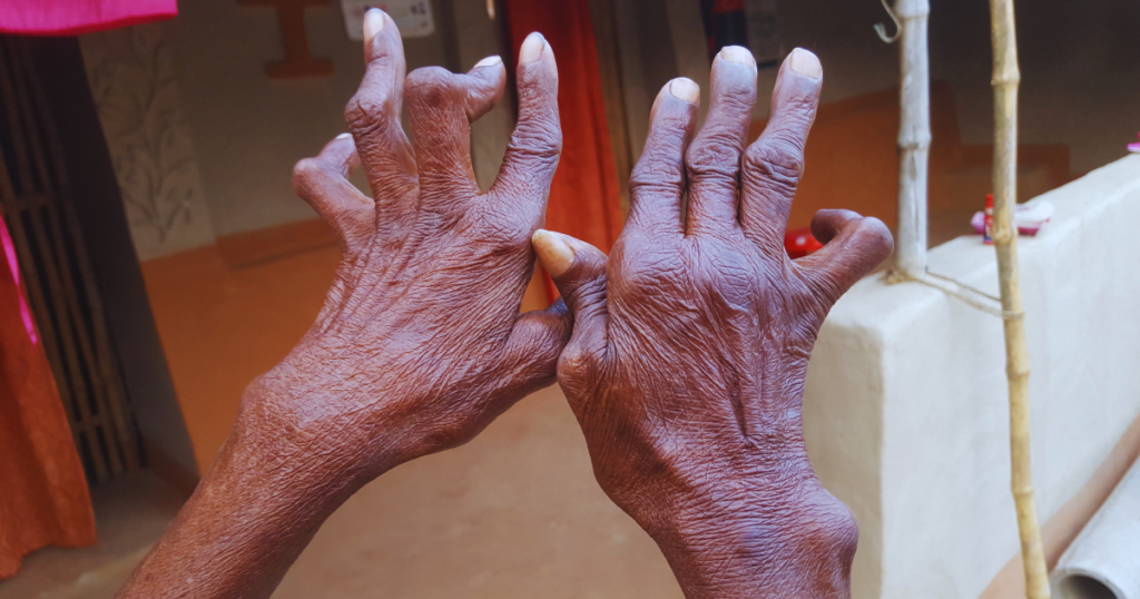 Rheumatoid Arthritis