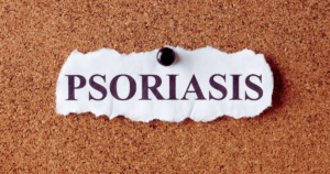 Psoriatic arthritis symptoms and treatment options for joint inflammation and skin issues.