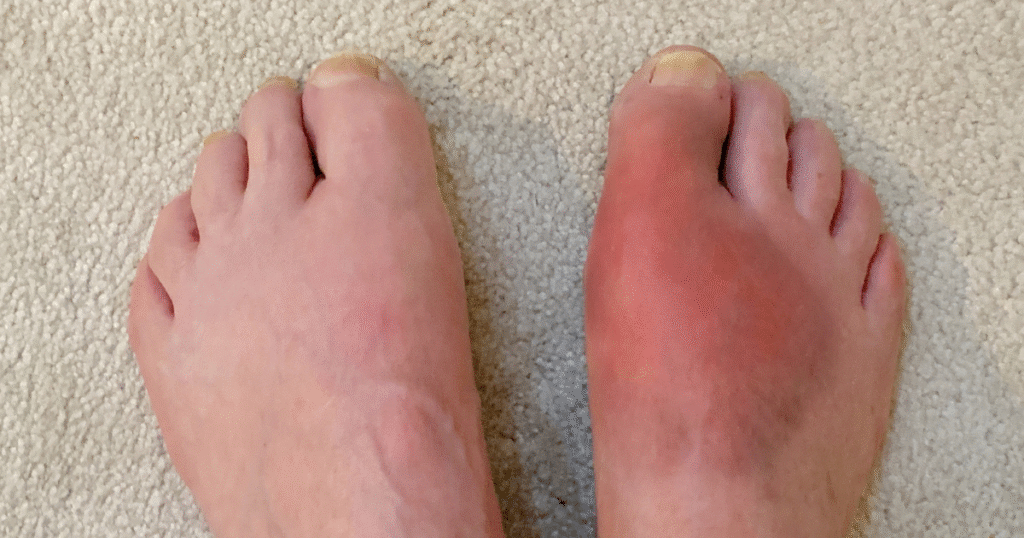 Gout in Women