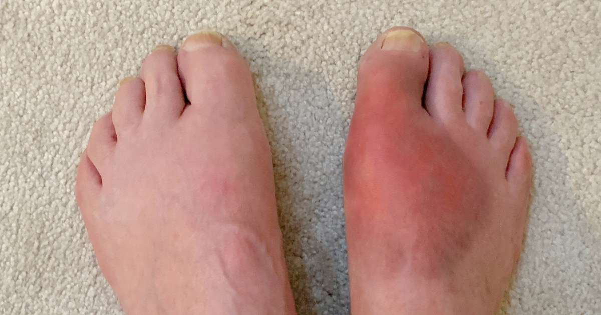 Gout in Women