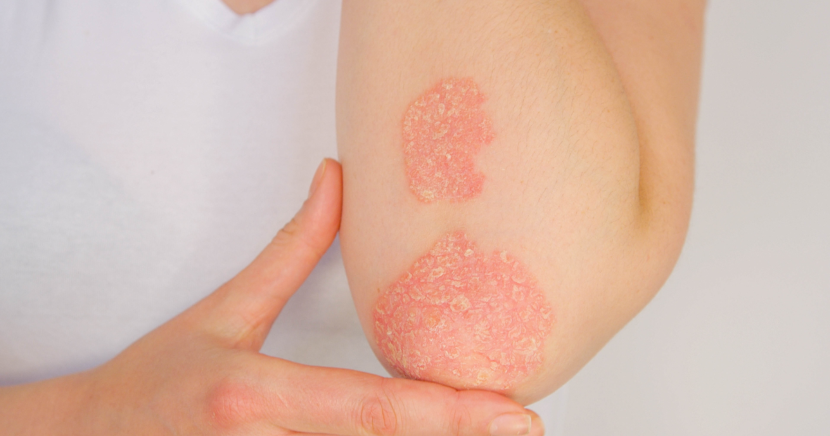 Psoriatic Arthritis