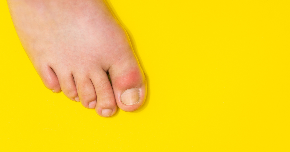 Gout and Kidney Health