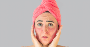 Lupus Butterfly Rash: Causes and Treatment Guide