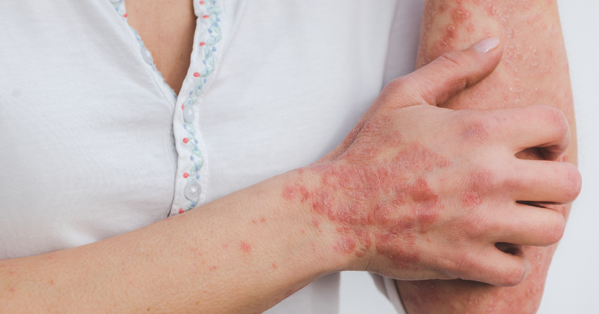 Lupus and Skin Sensitivity