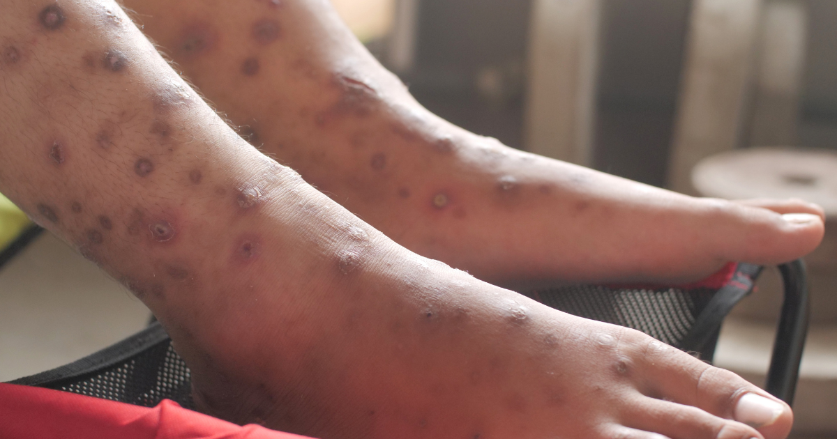 Vasculitis and Mental Health
