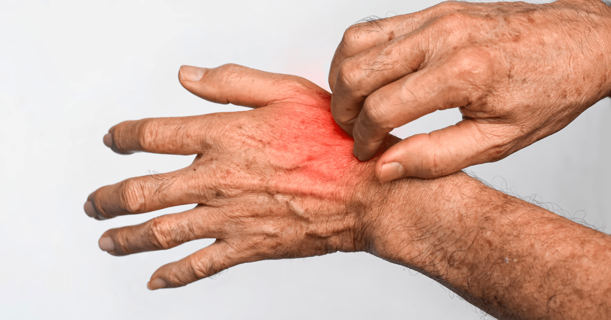 Weight Loss and Psoriatic Arthritis