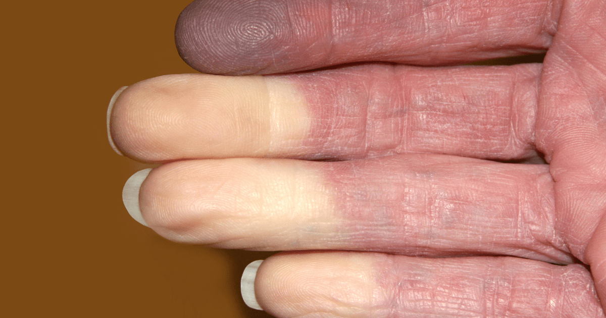 Raynaud