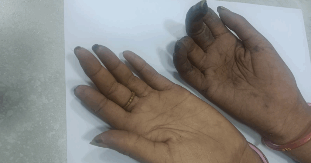 Raynaud’s in Scleroderma