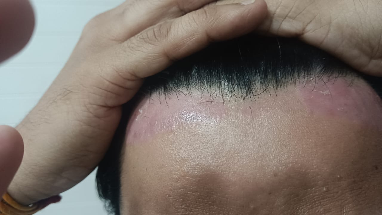स्कैल्प सोरायसिस