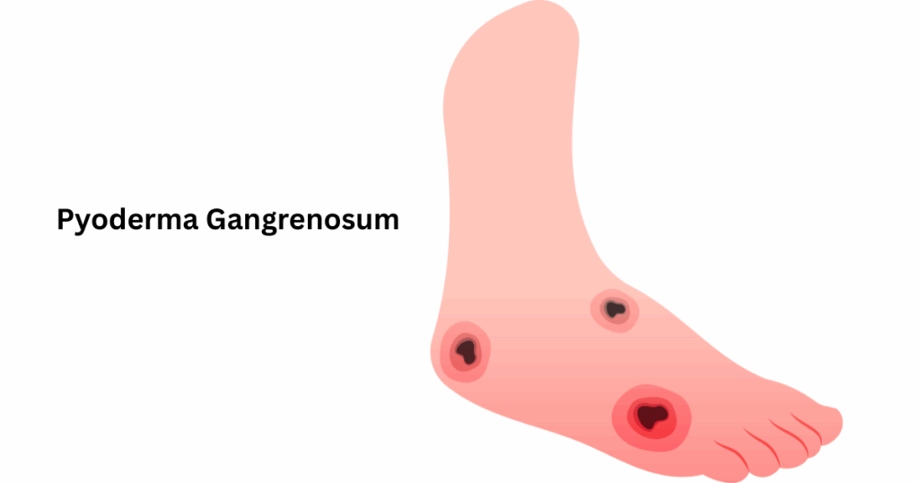 पायोडर्मा गैंग्रीनोज़म