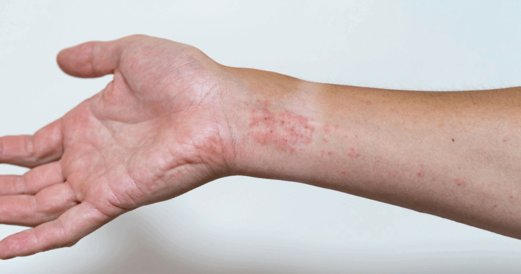 Skin rash in dermatomyositis patient illustration