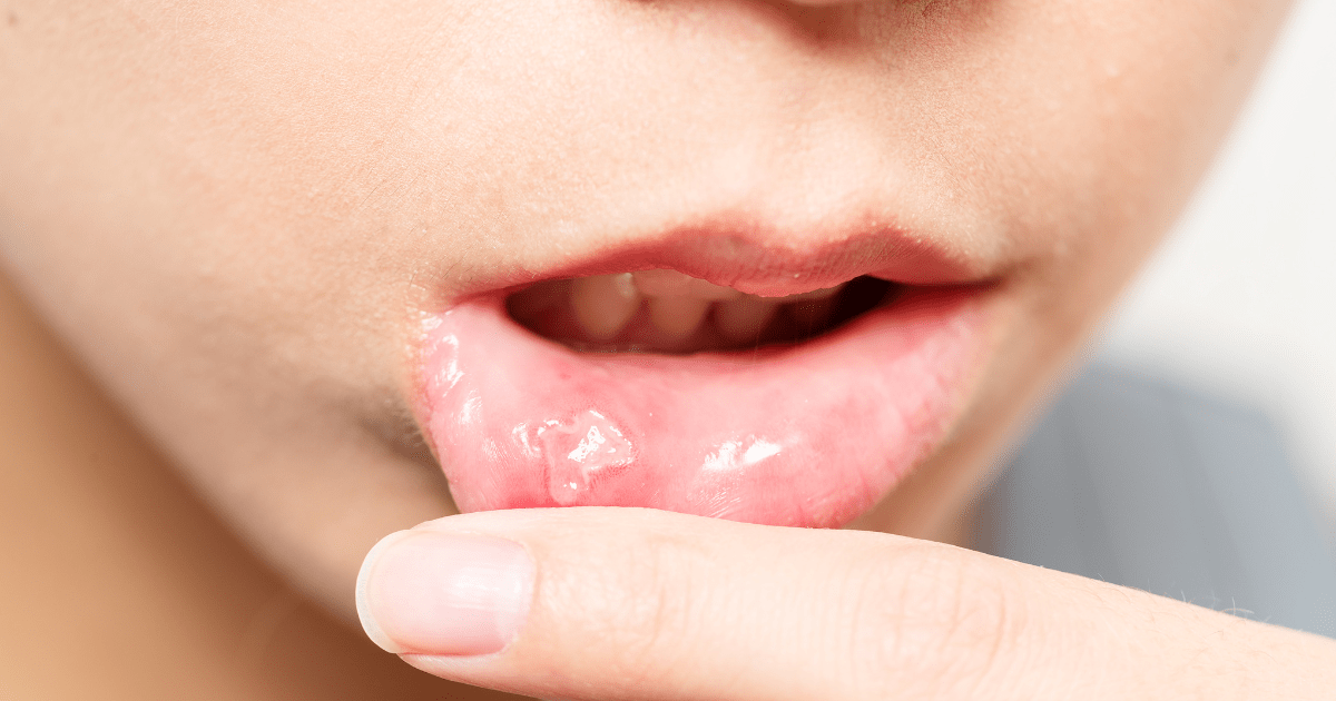 Oral ulcers in Behcet’s Disease