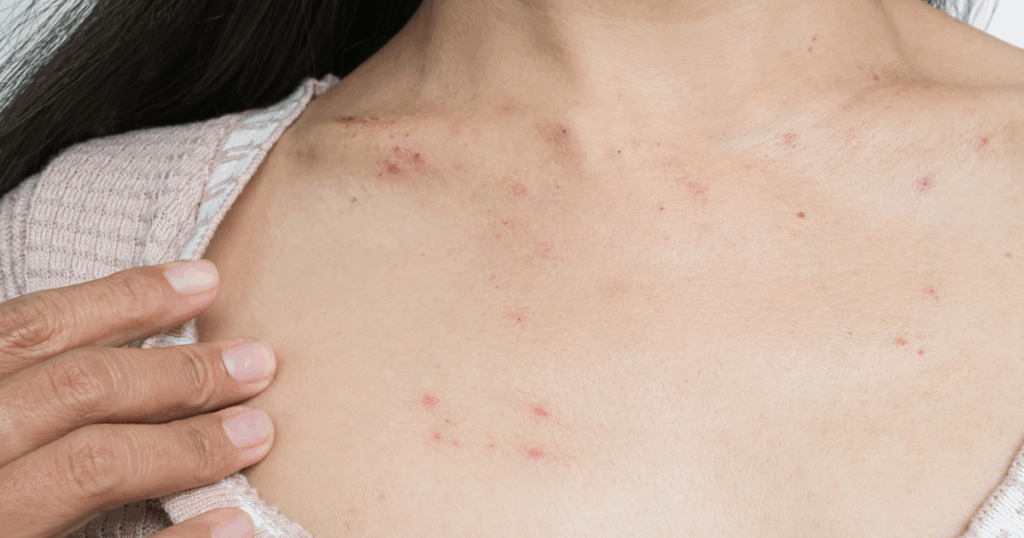 Dermatomyositis patient with skin rash at risk of skin cancer