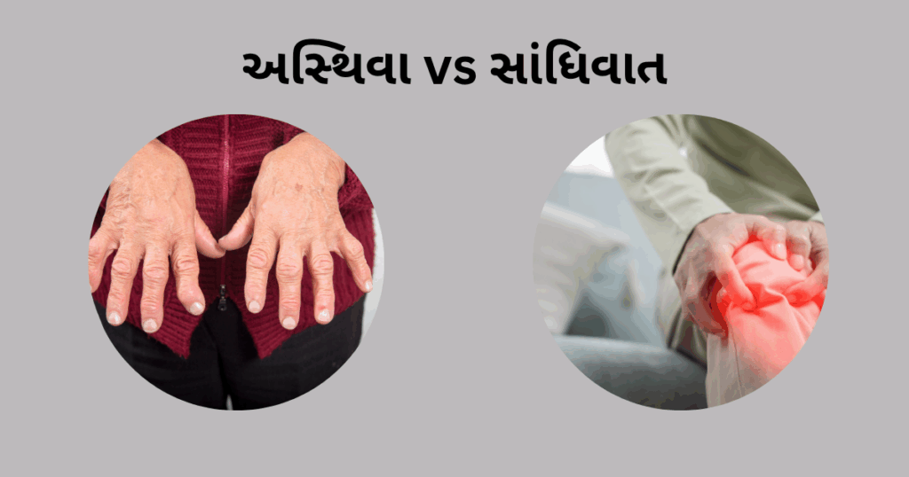 અસ્થિવા vs સાંધિવાત
