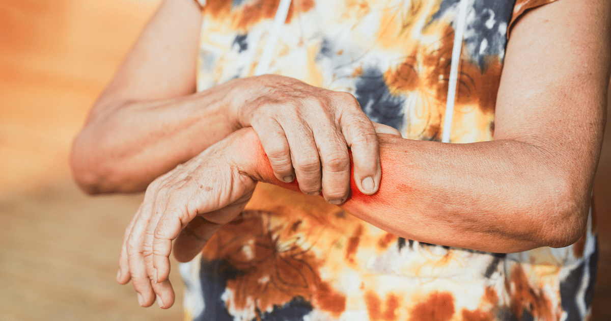 Lupus patient caring for skin and joints during winter season