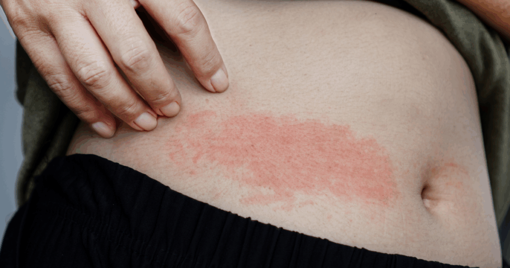 Dermatomyositis Sunscreens