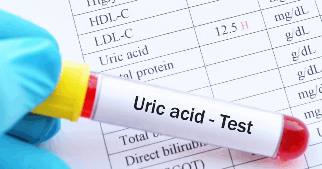 गाउट में यूरिक एसिड स्तर