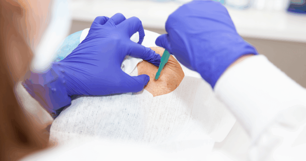 Skin biopsy for Pyoderma Gangrenosum