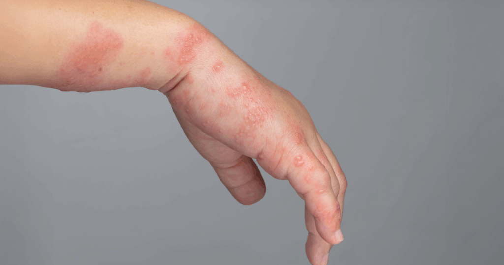 Juvenile dermatomyositis skin rash in children