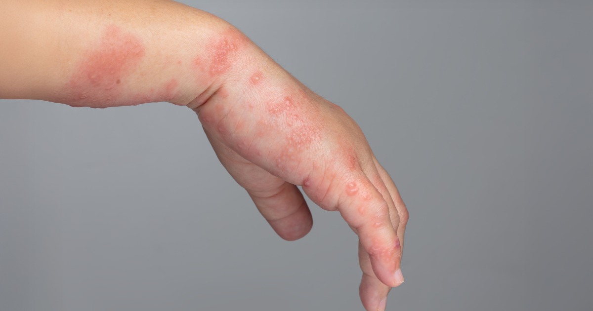Juvenile dermatomyositis skin rash in children