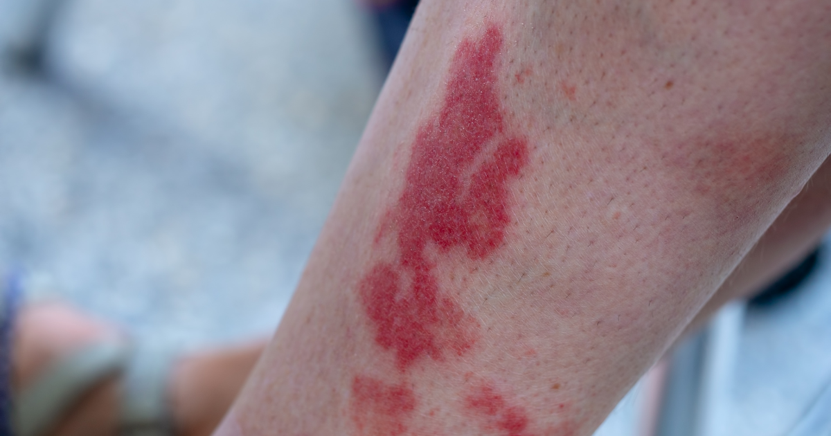 Inflammation and narrowing of blood vessels caused by vasculitis