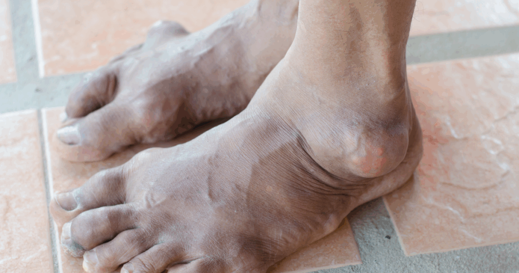 Is Gout an Autoimmune Disease or a Metabolic Disorder?