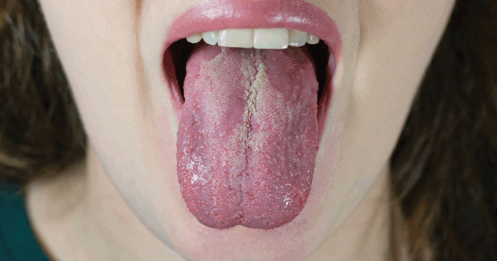 Sjogren’s Syndrome without dryness