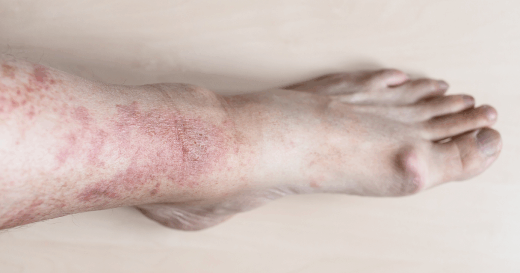 त्वचा के असामान्य बदलाव जो वास्कुलाइटिस का संकेत हों