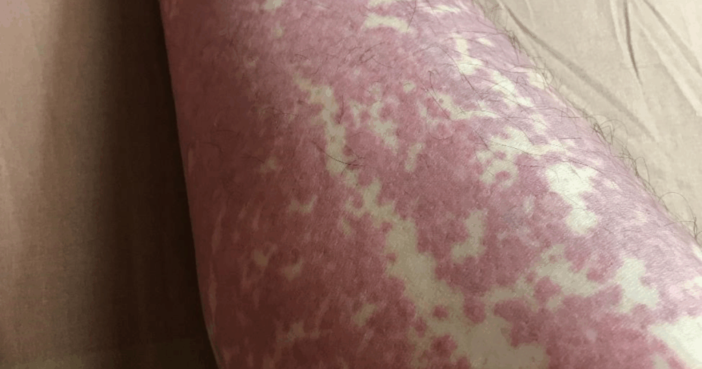 वास्कुलाइटिस