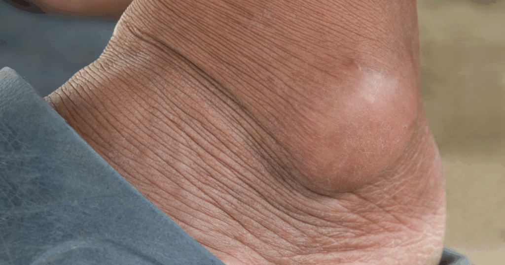 गाउट और जोड़ों का नुकसान