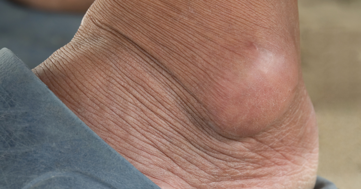 गाउट और जोड़ों का नुकसान