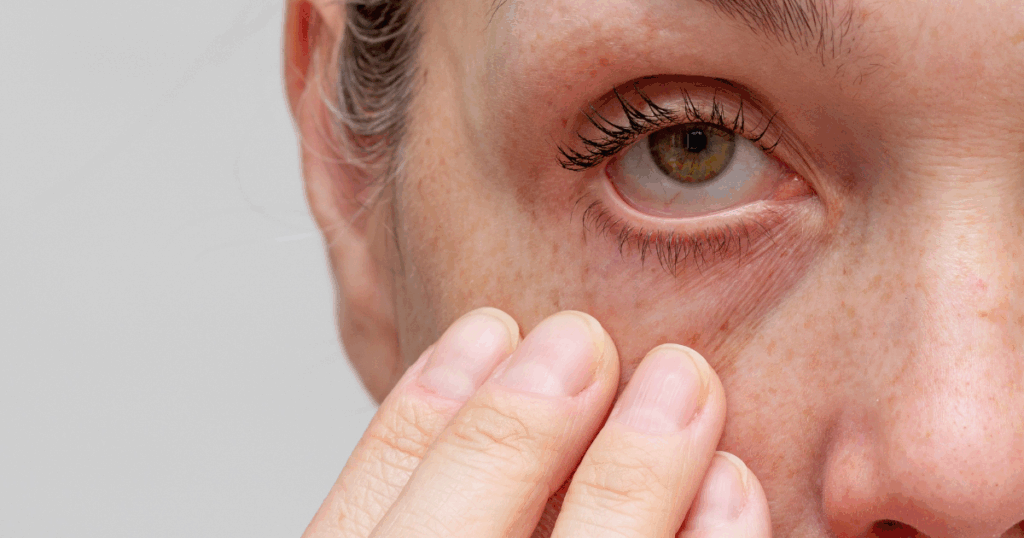 Sjogren’s Syndrome