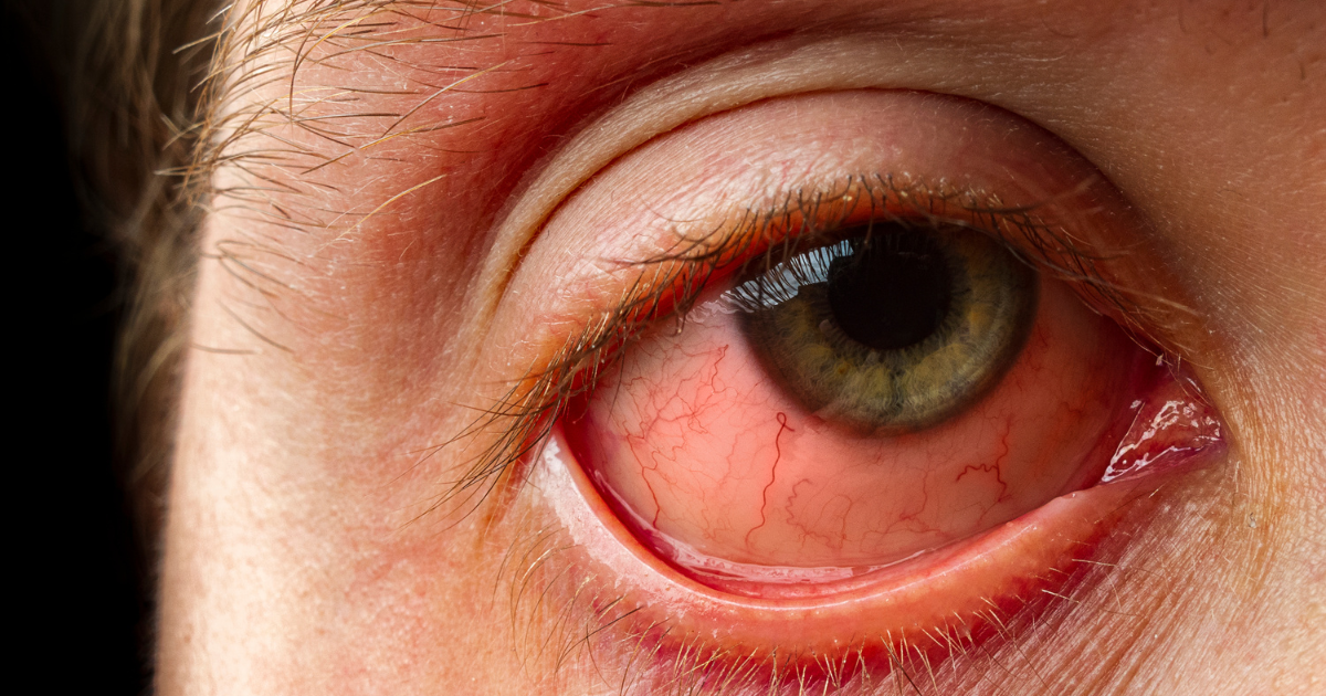 क्या स्जोग्रेन सिंड्रोम भविष्य में पूरी तरह ठीक हो सकता है?