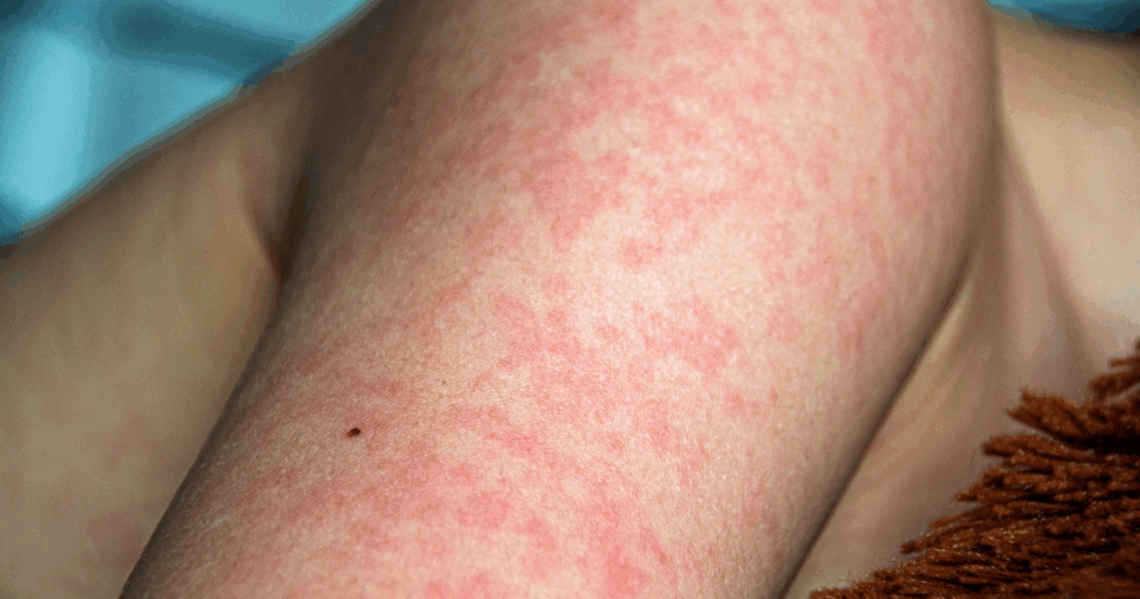 5 Early Signs of Vasculitis