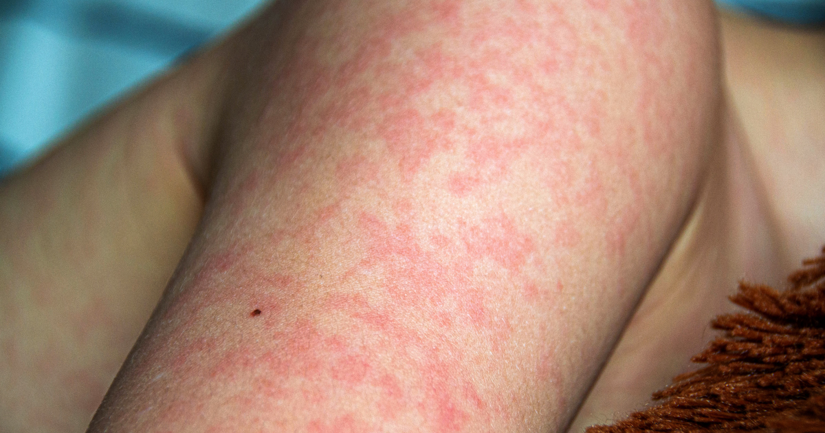 5 Early Signs of Vasculitis