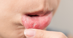 Behçet’s Disease Symptoms & Diagnosis