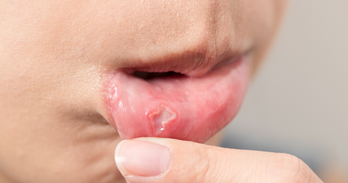Behçet’s Disease Symptoms & Diagnosis