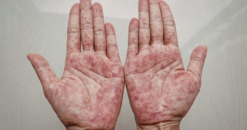 Best Daily Routine for Lupus Patients