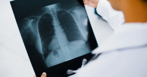 Lung Disease in Sjogren’s syndrome
