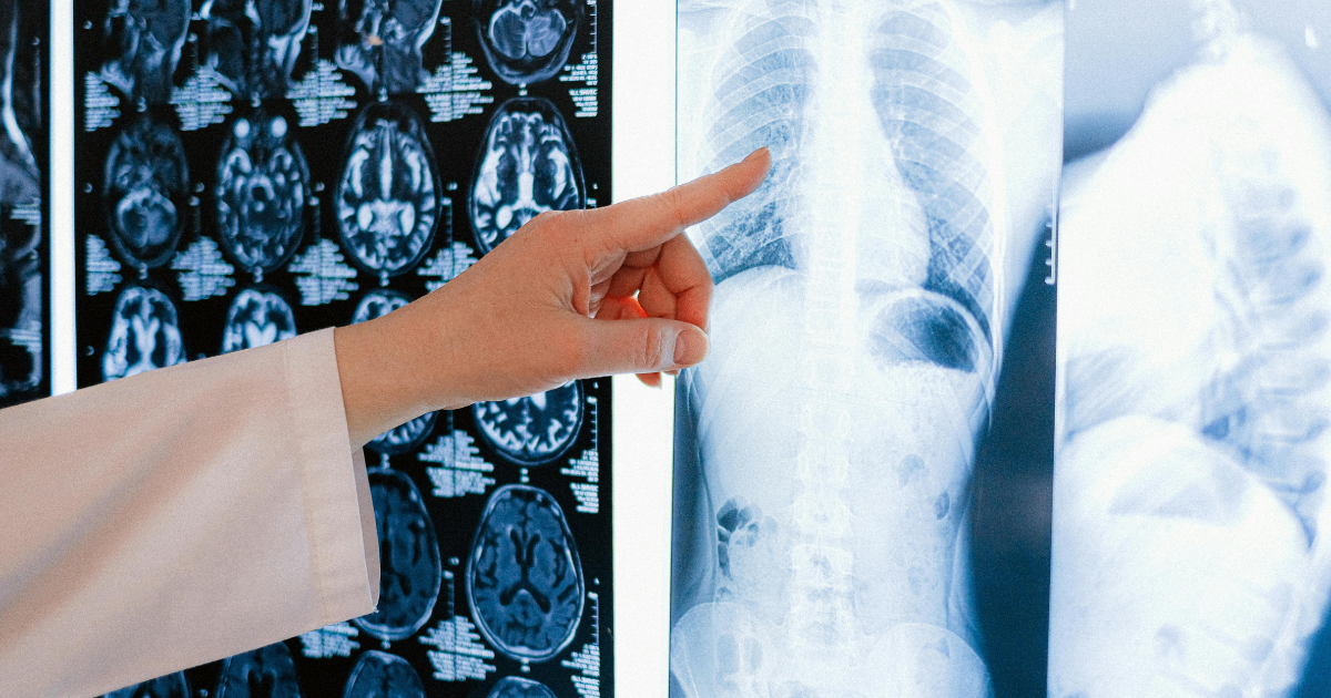 X-ray vs MRI in Ankylosing Spondylitis
