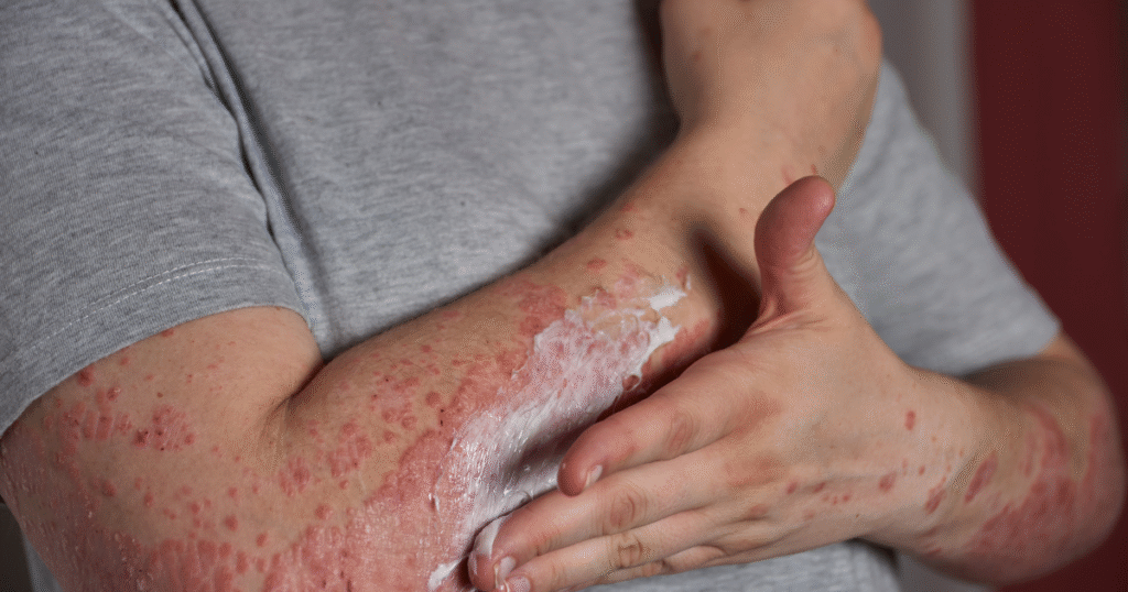 Daily Routine That Reduces Vasculitis Flares