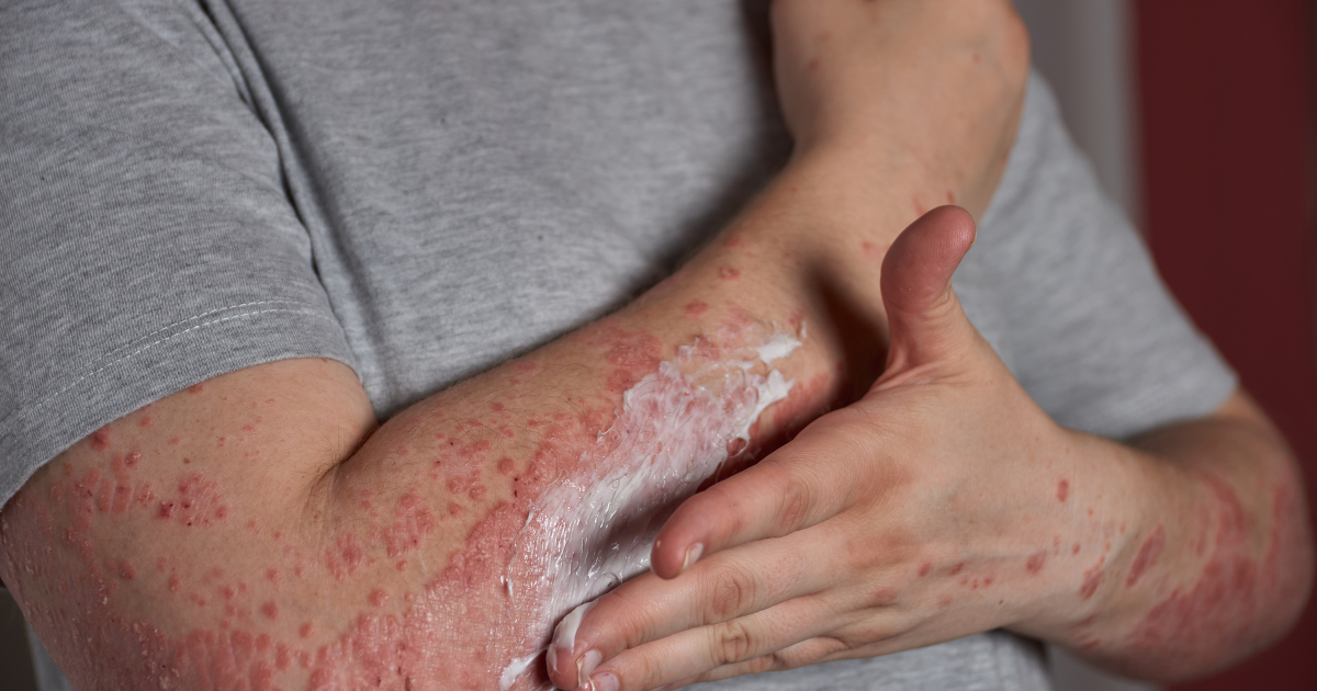Daily Routine That Reduces Vasculitis Flares