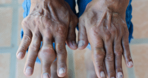 gout attack in rainy season