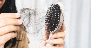 Hair Loss in Lupus