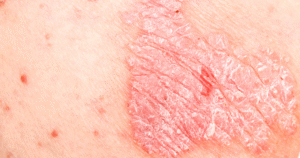 What Happens When Psoriatic Arthritis Treatment Stops Working