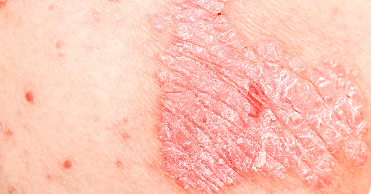 What Happens When Psoriatic Arthritis Treatment Stops Working