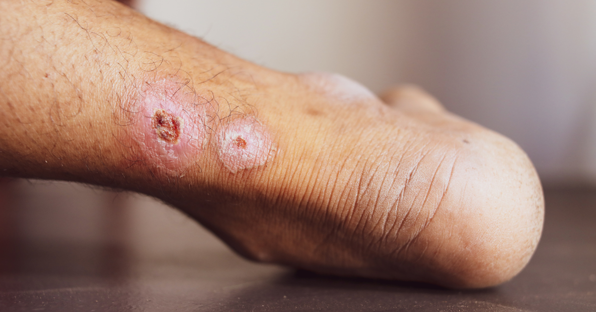 Can Vasculitis Cause Skin Ulcers That Won't Heal?
